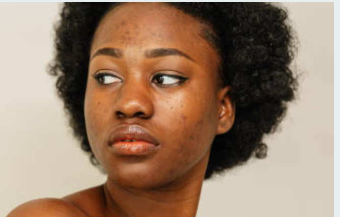 How to Get Rid of Dark Spots, Acne, Hyperpigmentation And Breakouts with African Black Soap
