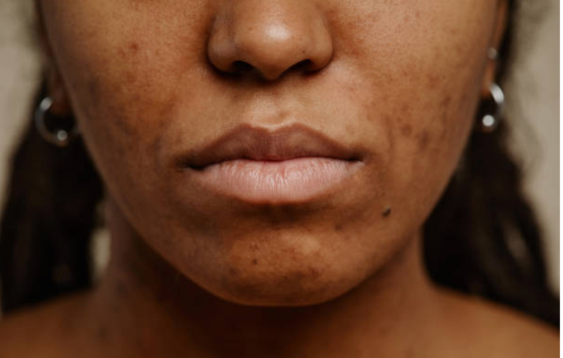 If Your Skin Reacts to Everything You Try, This Is Probably Why. And How to Reset It.