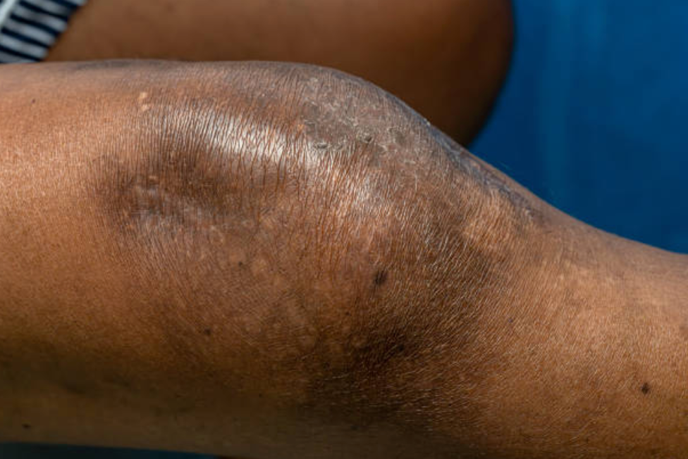 Dark Knees and Elbows: Why They Happen and the Natural Routine That Fades Them