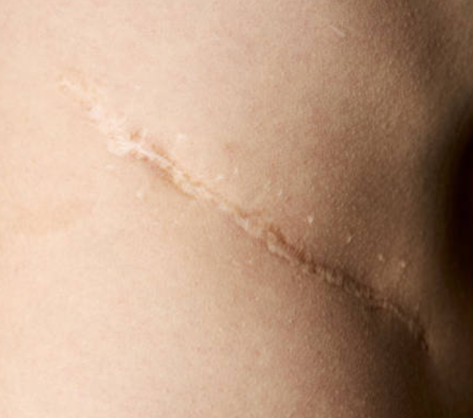 Does Natural Skincare Actually Help Fade Scars? What the Evidence Says