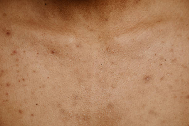 Why Your Skin Darkened Over Summer And the Natural Routine That Reverses It