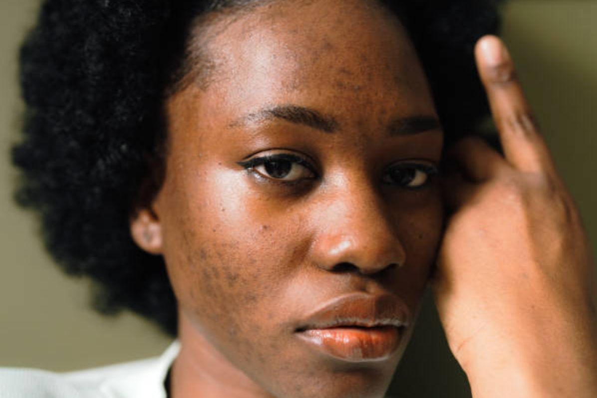 Shea Butter for Hyperpigmentation: How Vitamins A and E Fade Dark Spots Naturally