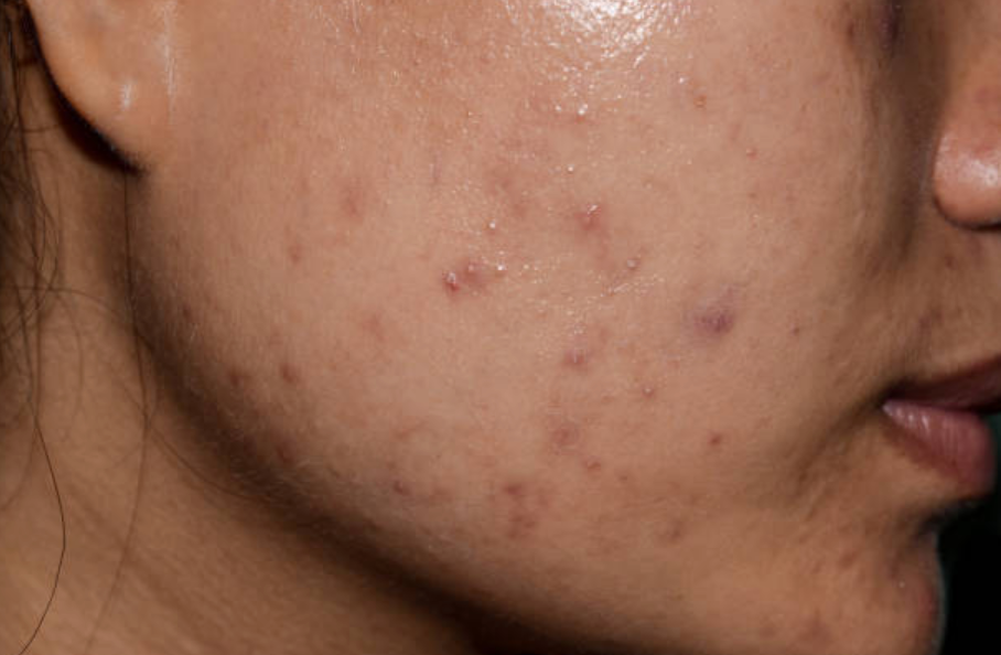 Using a Facial Oil on Oily Skin Sounds Wrong - Here's Why It's Actually Brilliant