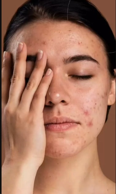 How to Treat Hyperpigmentation Naturally: Effective Remedies for Pigmentation on Face & Post-Inflammatory Hyperpigmentation